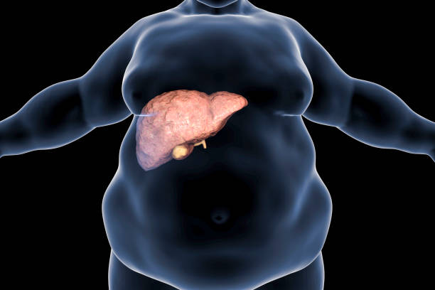 Healing Fatty Liver: Ayurvedic Insights